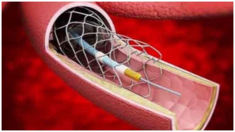 Cardiac stent prices hiked